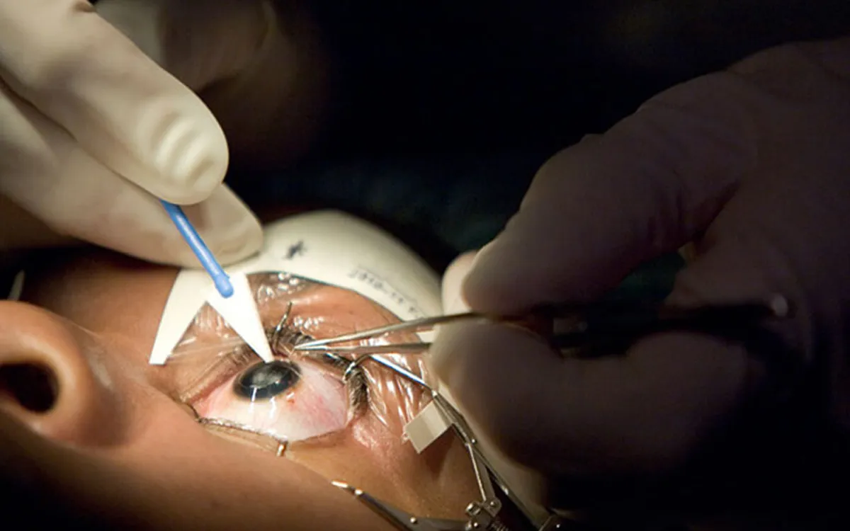 Safe Laser Eye Surgery Procedure